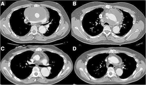 Multi-slice computed tomography (CT) of the chest. Preoperative CT shows a huge mediastinal fluid collection surrounding both A) the ascending, and B) aortic arch prosthetic grafts having a diameter of 15 cm with a low density (12-18 Hounsfield Units). Postoperative CT shows omental wrapping with normal density (65-80 Hounsfield Units) around the C) the ascending, and D) aortic arch prosthetic grafts without evidence of fluid collection or infectious sequela 18 months after the operation.